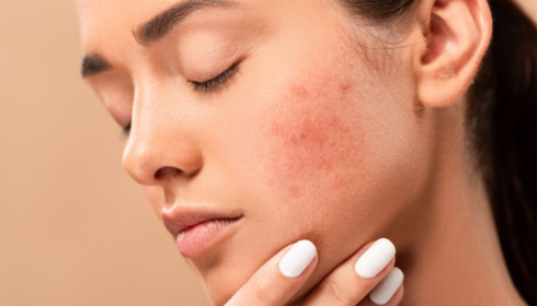 hyperpigmentation